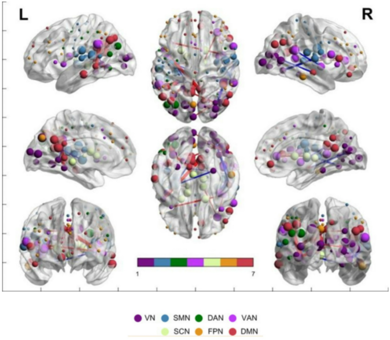 Brain network functional connectivity changes induced by music-induced analgesia in fibromyalgia patients