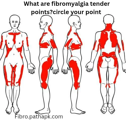 What are fibromyalgia tender points?
