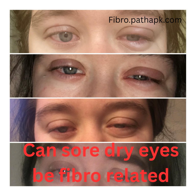 Can sore dry eyes be fibro related ?