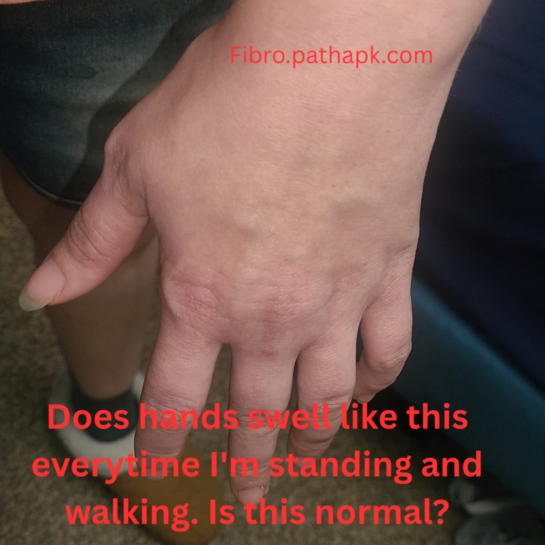 Does hands swell like this everytime I’m standing and walking. Is this normal?