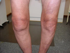 “I am seeking others who have a dual diagnosis of osteoarthritis and fibromyalgia.”