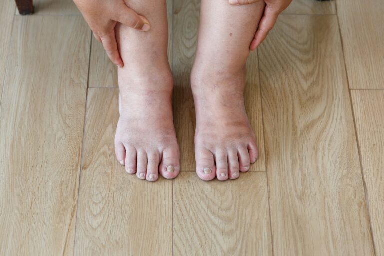 What Is Diabetic Peripheral Neuropathy?