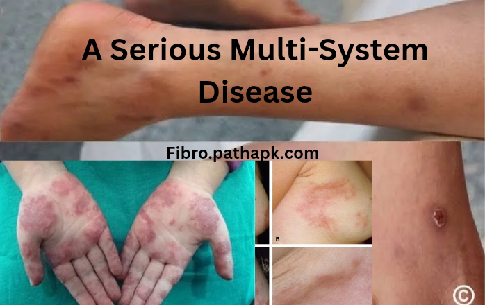 A Serious Multi-System Disease