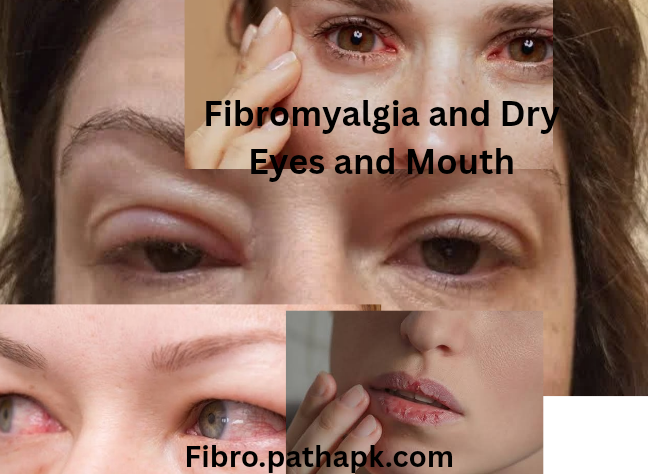 Fibromyalgia and Dry Eyes and Mouth
