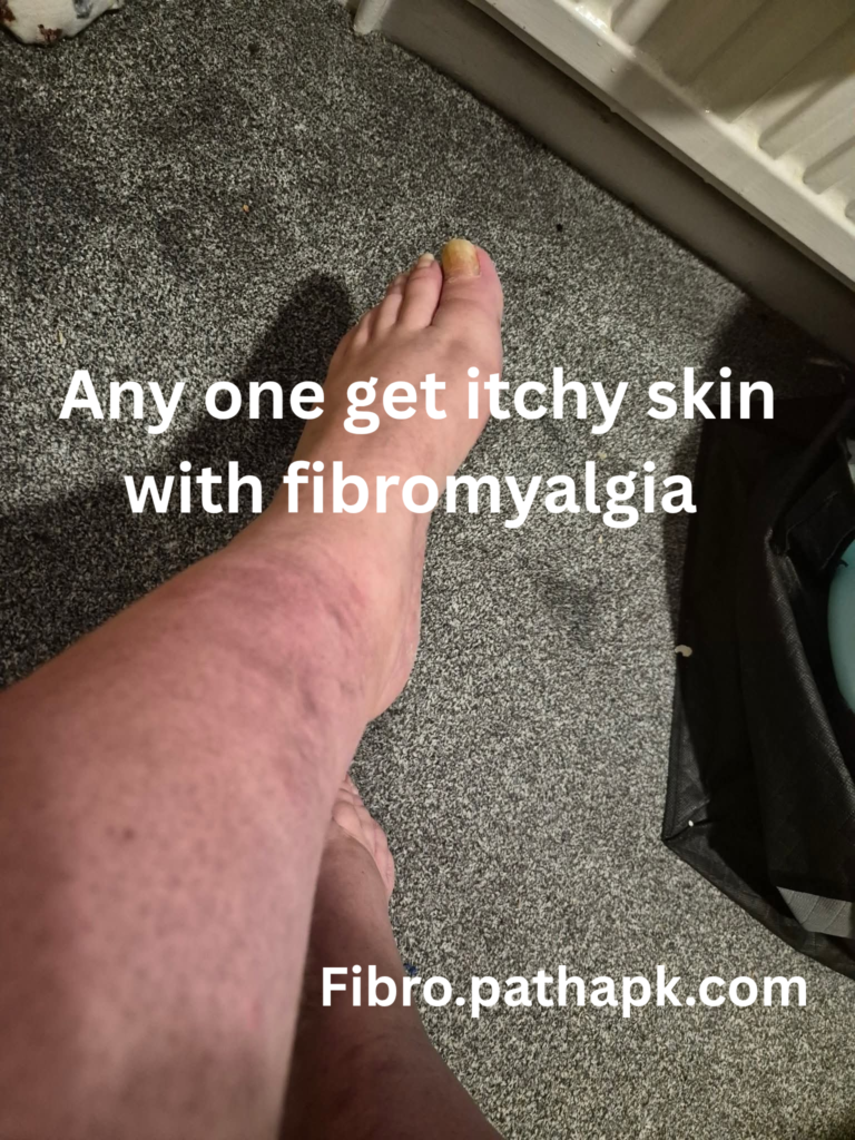 Any one get itchy skin with fibromyalgia