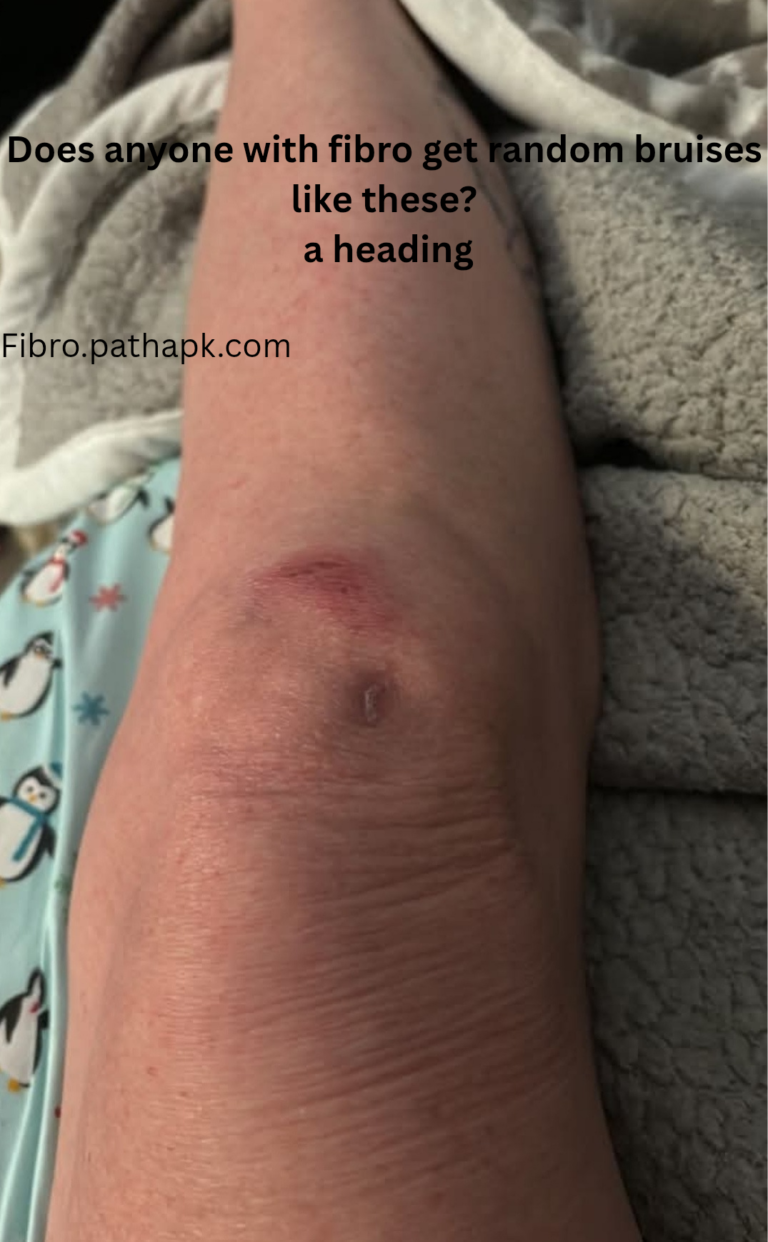 Does anyone with fibro get random bruises like these?