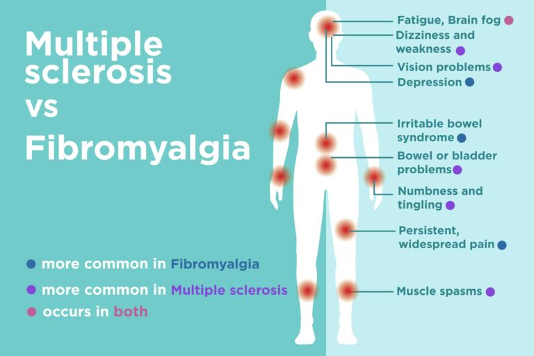Has anyone considered weather it might actually be multiple sclerosis instead of Fibromyalgia?