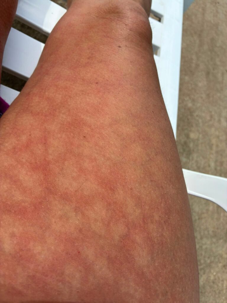 Anyone Else Have Arms and/or Legs That Do This?