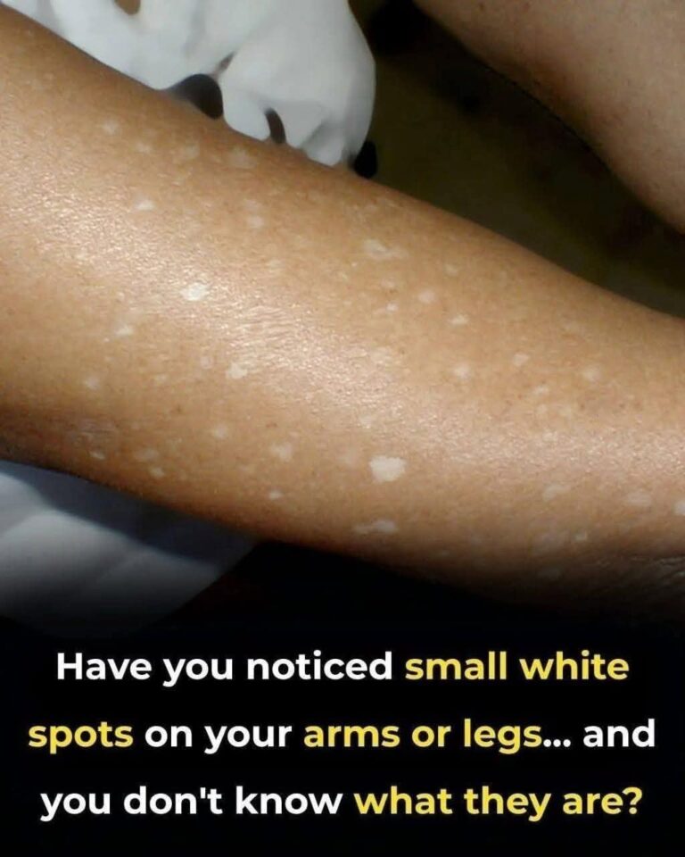 Have You Noticed Small White Spots on Your Arms or Legs?