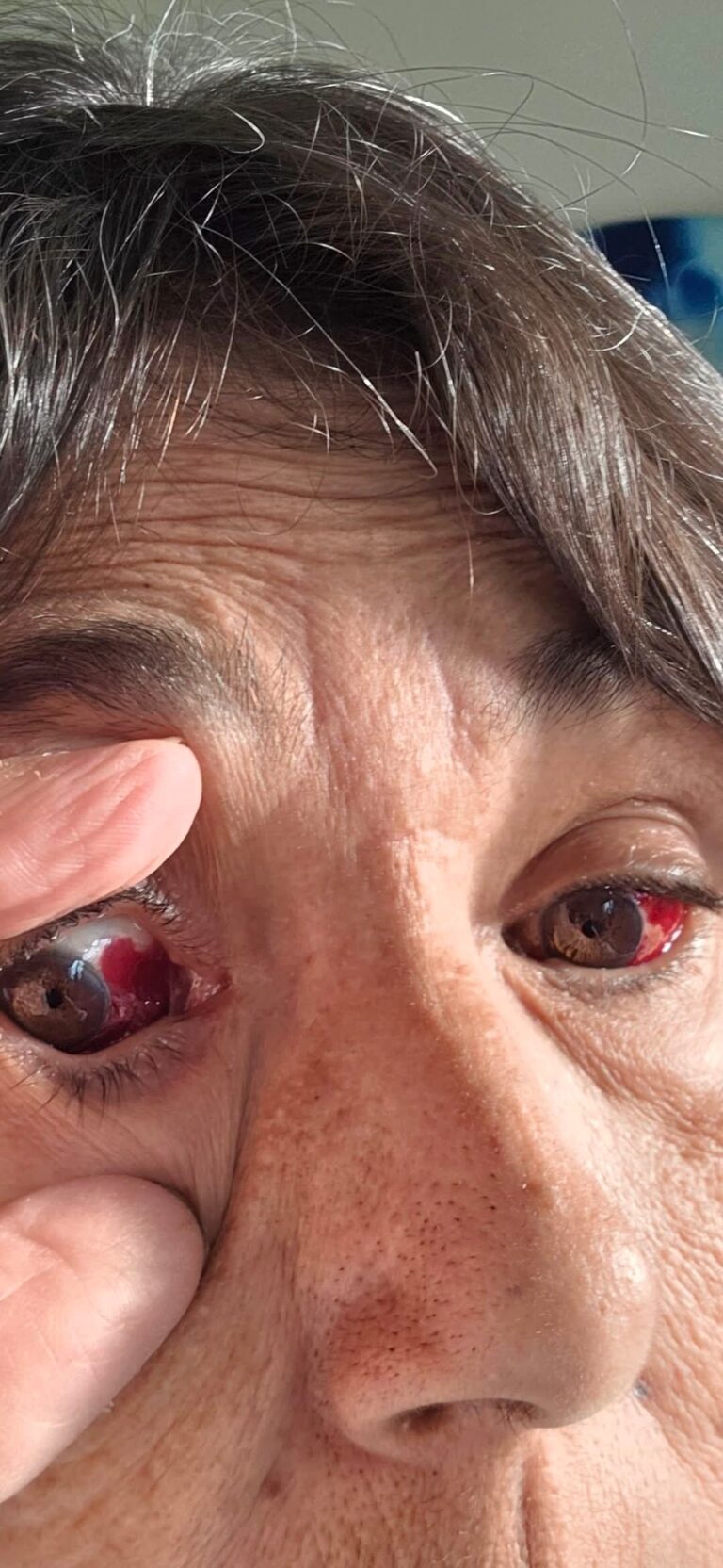 Does anyone get blood shot eyes this bad with fibromyalgia and how do we stop it more why does this happen?