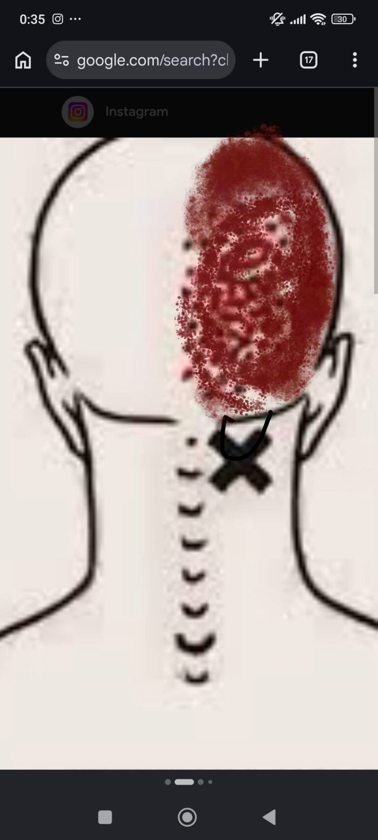 The area marked in red in the photo is my right side, my temple, behind my ear, and it’s been hurting for 17 days. I’m scared 😭