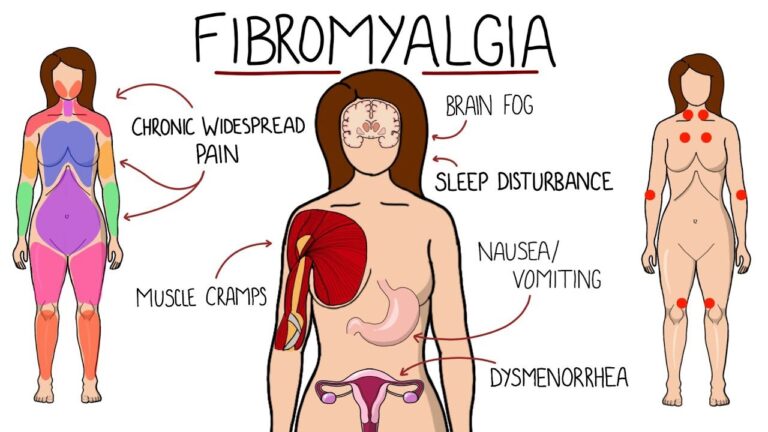 Common Conditions that Mimic Fibromyalgia