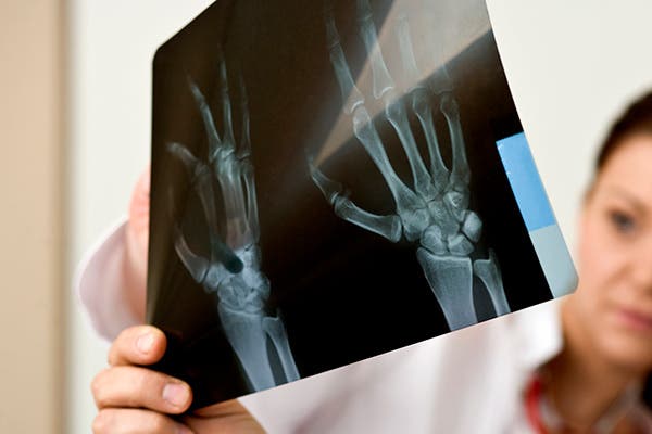 Fibromyalgia Linked to Hand Diseases