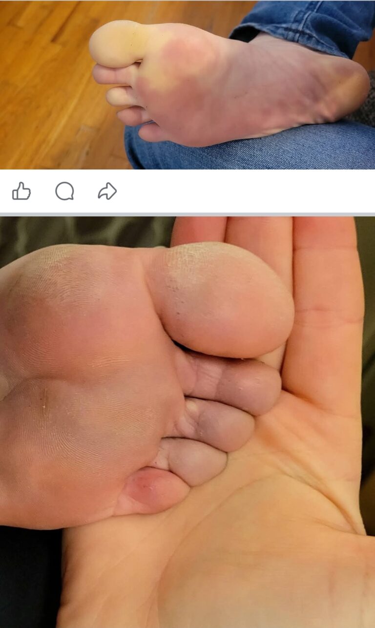 Does anyone else get raynauds phenomenon just in the toes?