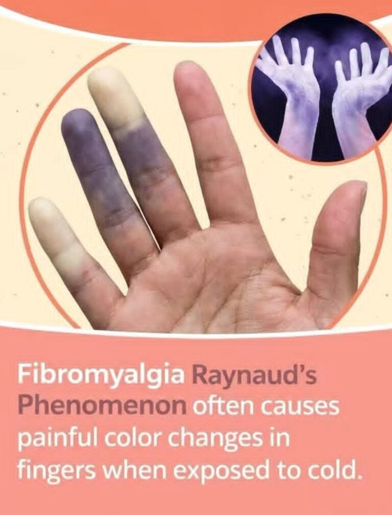 When Cold Turns Into Pain: More Than Just “Cold Hands”